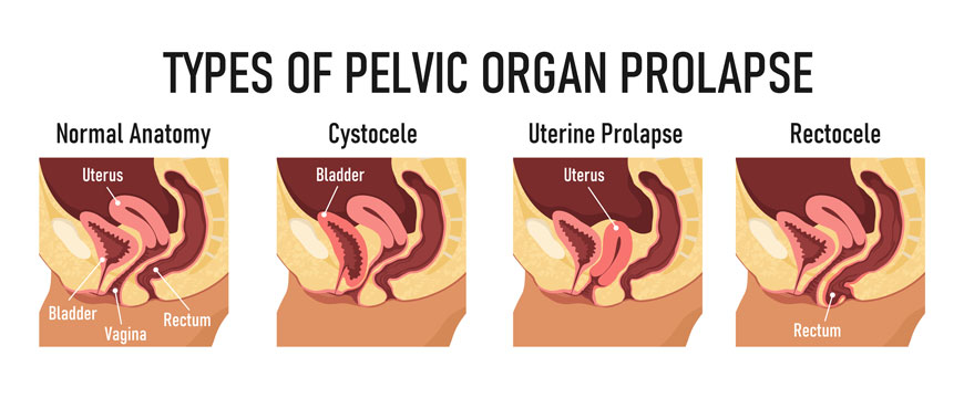 Colporrhaphy (Vaginal Wall Repair) - What you need to know - Mater