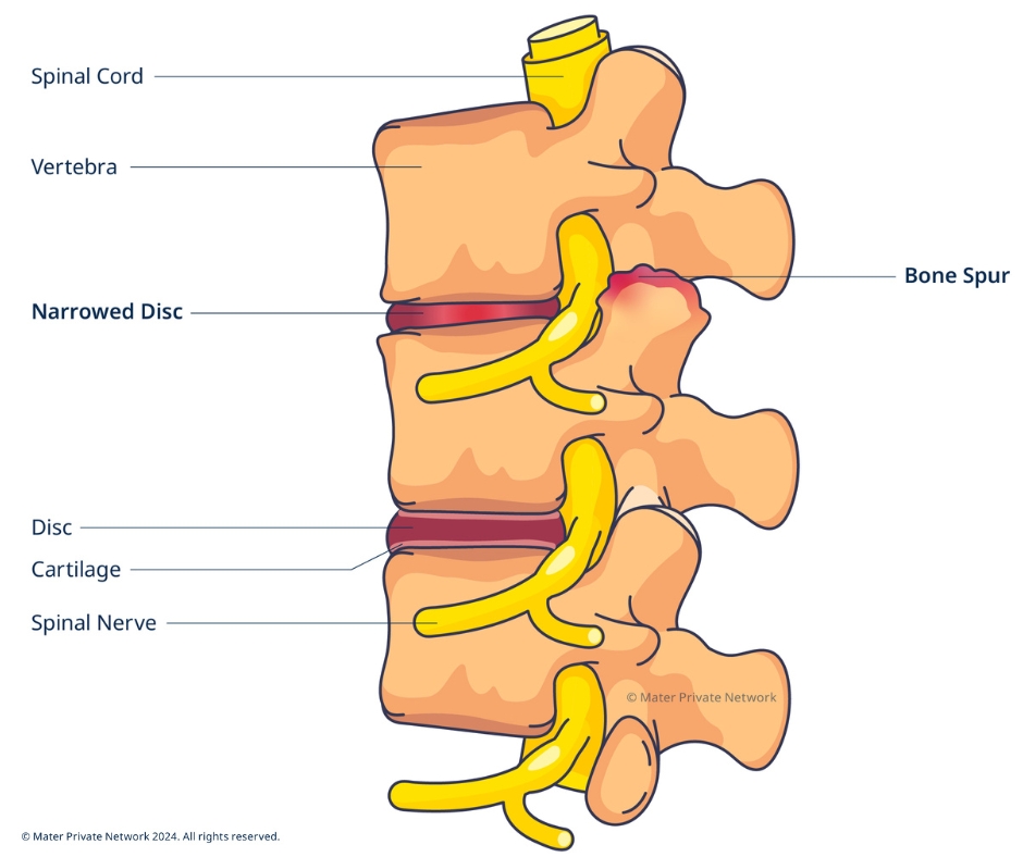 Bone spur