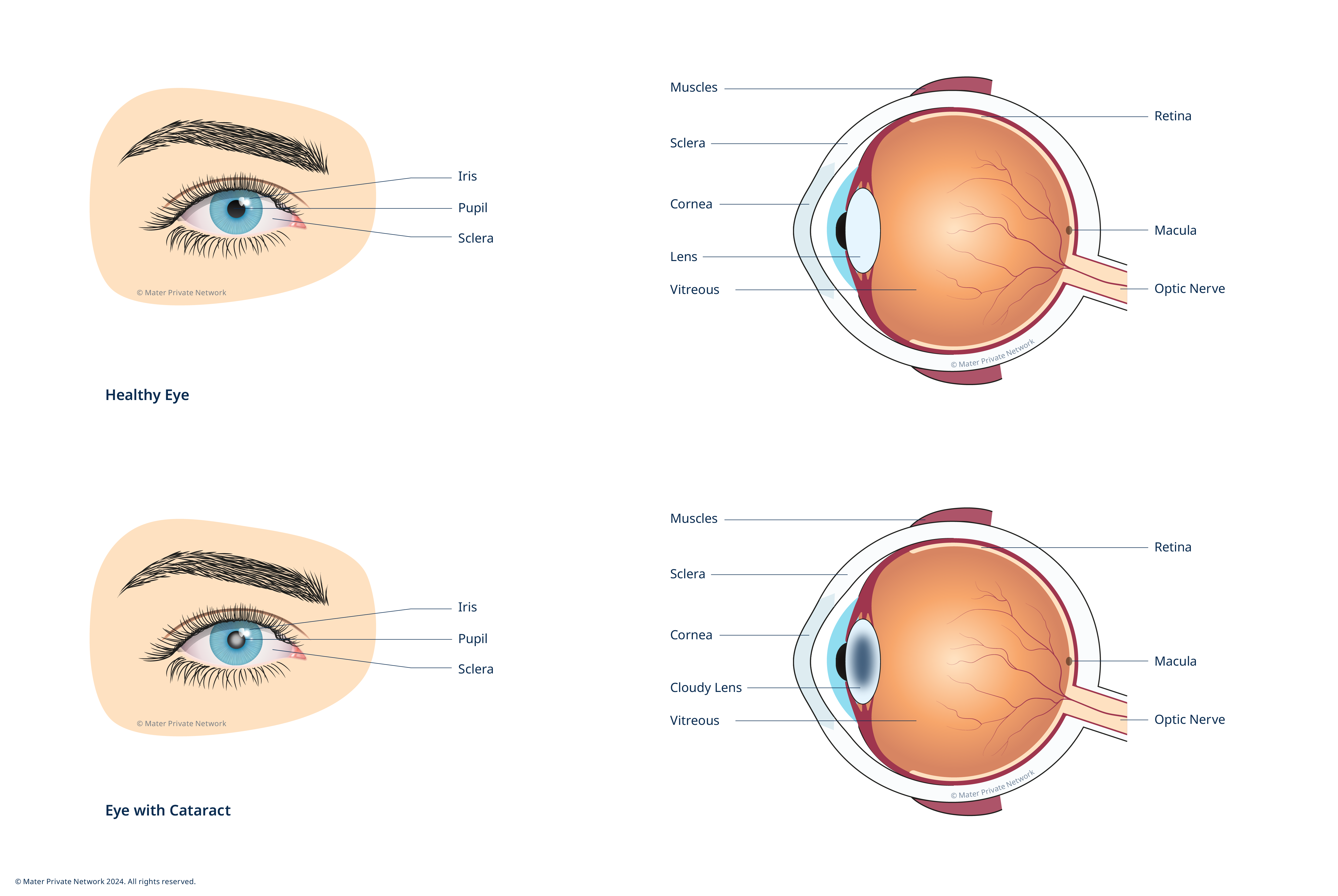 Cataracts