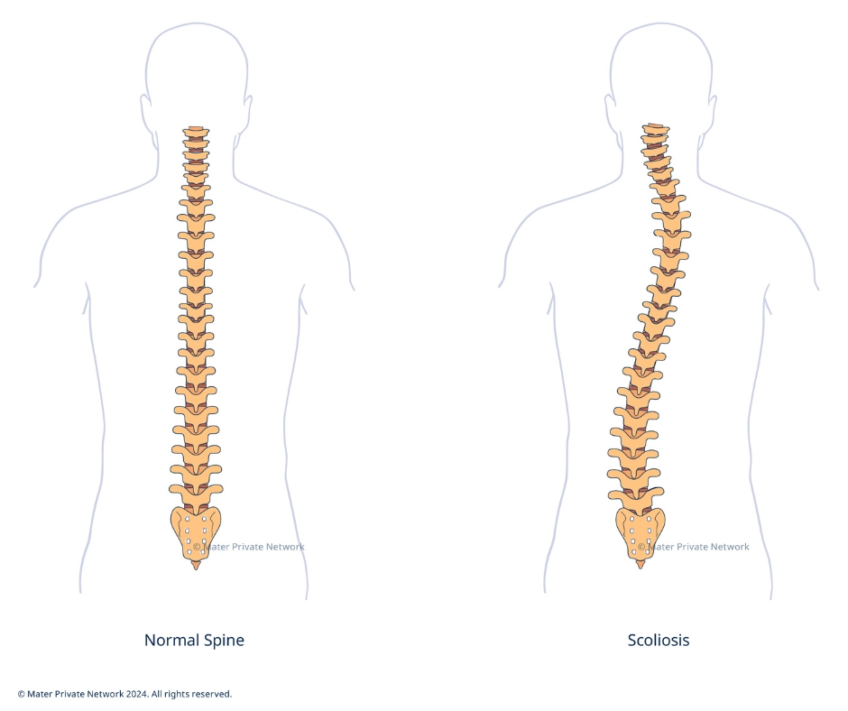 Scoliosis